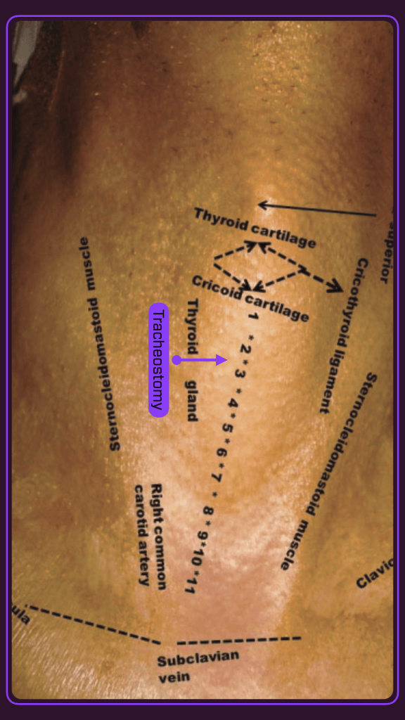 Anatomical illustration showing the tracheostomy site, including labeled structures such as the thyroid cartilage, cricoid cartilage, and major vessels in the neck.