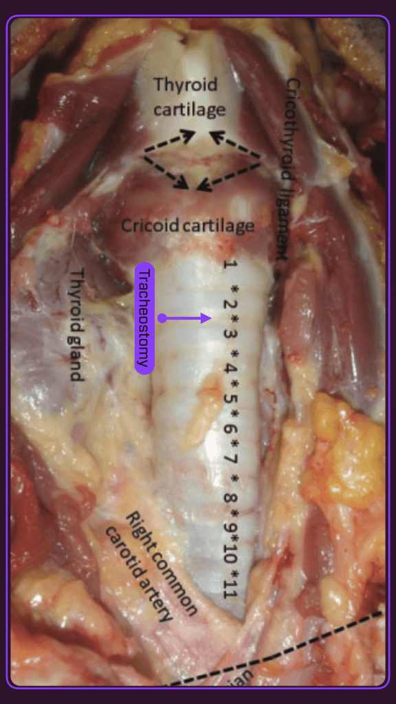 Anatomical diagram of the neck illustrating tracheostomy placement, thyroid and cricoid cartilages, and surrounding structures like the right common carotid artery.