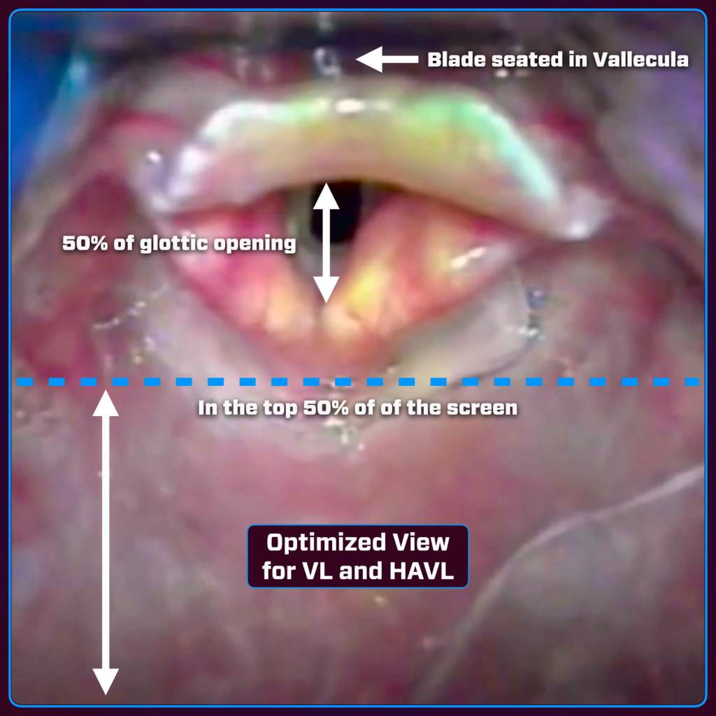 Close-up view of a larynx showing the glottic opening with annotations indicating optimal placement of the video laryngoscope blade in the vallecula and guidelines for achieving the best visualization during intubation.