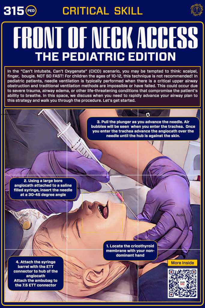 An instructional poster illustrating the Front of Neck Access procedure for pediatric patients, depicting step-by-step guidance on performing needle ventilation, including visuals of the airway anatomy and necessary equipment.