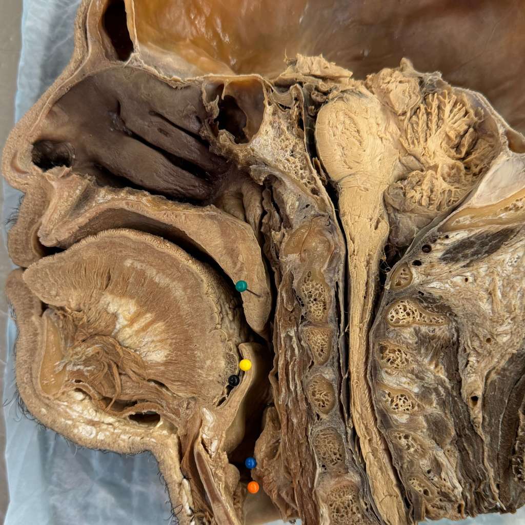 Cross-sectional view of a cadaveric specimen highlighting the airway anatomy with color-coded markers indicating different structures.