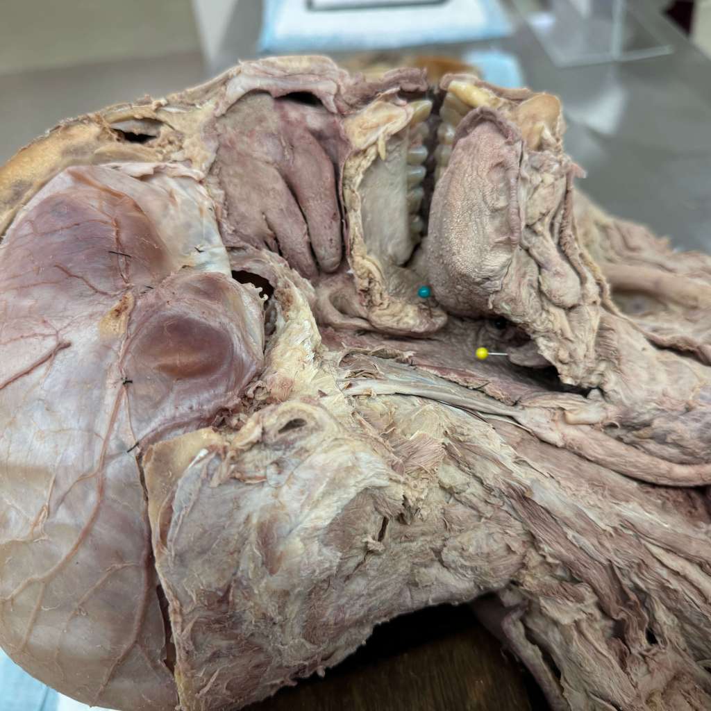Close-up view of a dissected human airway, showcasing anatomical structures such as the trachea and surrounding tissues, with colored markers indicating specific areas of interest.