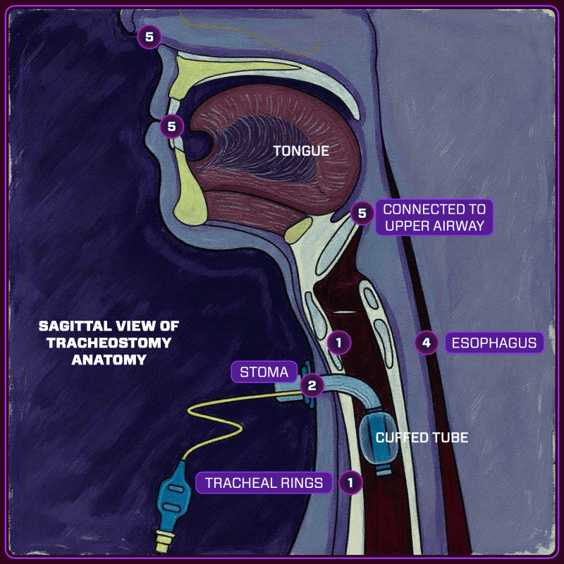 Tracheostomy Anatomy That Makes A Difference The Protected Airway 